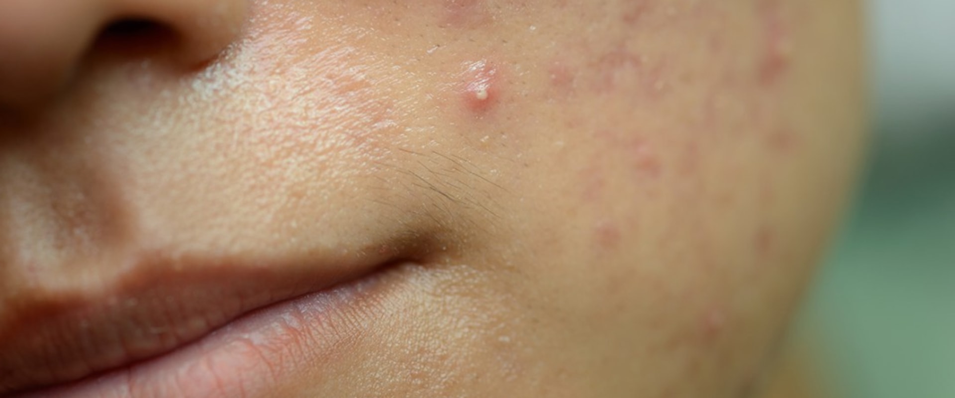 Antibiotics for Acne: Exploring Treatment Options